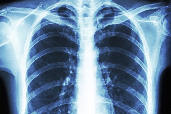 استفاده از تمامی ظرفیت‌های رادیولوژی برای تشخیص و مقابله با کرونا